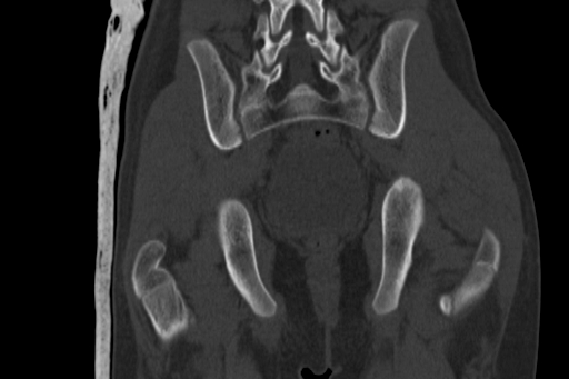 Anterior inferior iliac spine avulsion injury (Radiopaedia 88666-105376 Coronal bone window 49).jpg