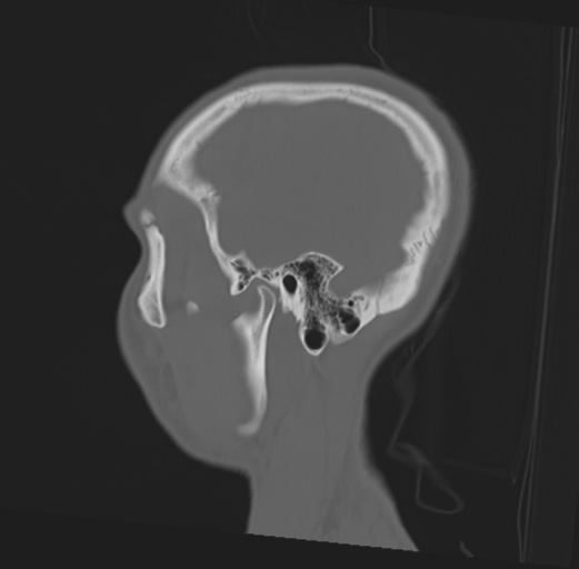 File:Anterior nasal spine fracture (Radiopaedia 46138-50494 Sagittal bone window 46).png