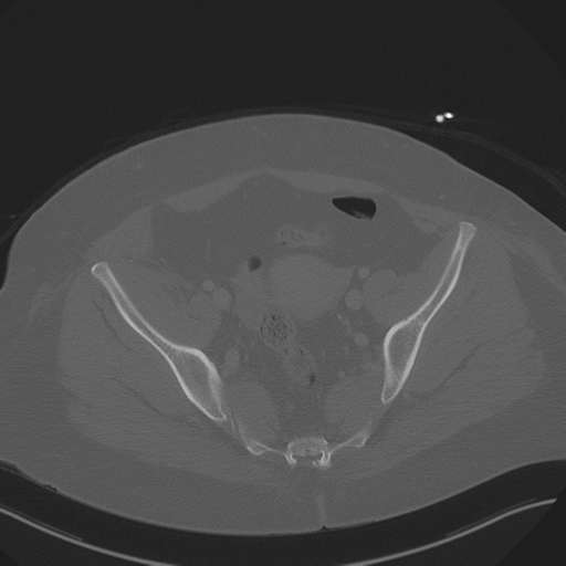 Anterior superior iliac spine avulsion fracture (Radiopaedia 44541-48244 Axial bone window 82).png