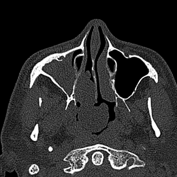 Antrochoanal polyp (Radiopaedia 30002-30554 Axial bone window 22).jpg