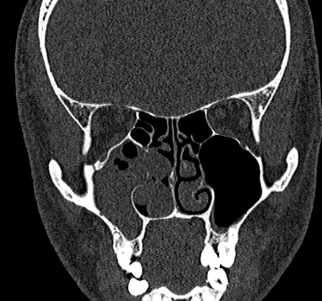 Antrochoanal polyp (Radiopaedia 30002-30554 Coronal bone window 41).jpg
