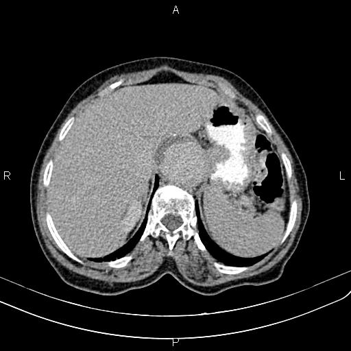 Aortic aneurysm and Lemmel syndrome (Radiopaedia 86499-102554 Axial C+ delayed 16).jpg