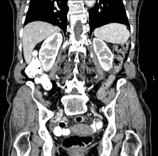 Aortic aneurysm and Lemmel syndrome (Radiopaedia 86499-102554 C 47).jpg