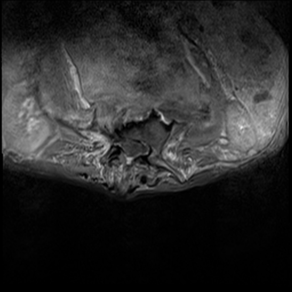 File:Aortic aneurysm with spinal destruction (Radiopaedia 42301-45409 Axial T1 fat sat 14).jpg
