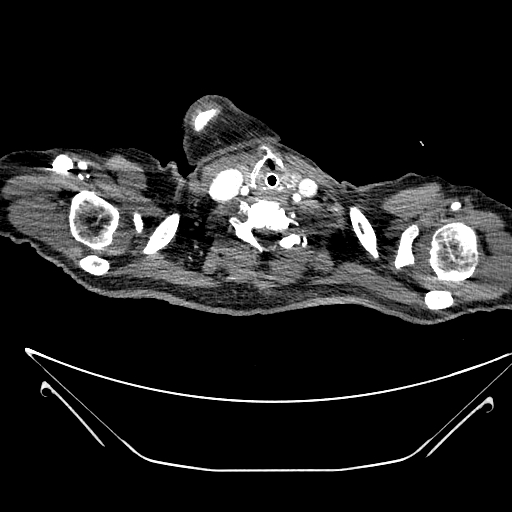 Aortic arch aneurysm (Radiopaedia 84109-99365 B 8).jpg