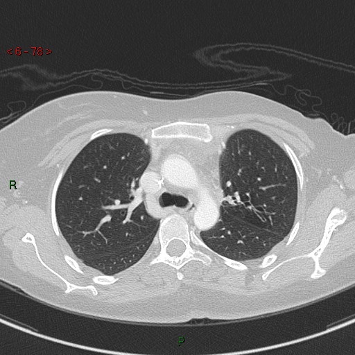 Aortic arch origin of left vertebral artery (Radiopaedia 51520-57286 Axial lung window 78).jpg