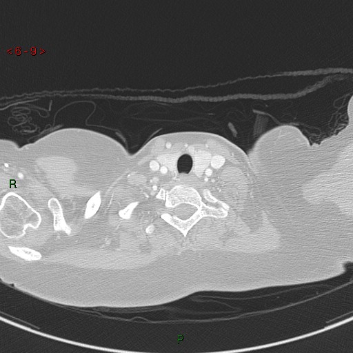 Aortic arch origin of left vertebral artery (Radiopaedia 51520-57286 Axial lung window 9).jpg