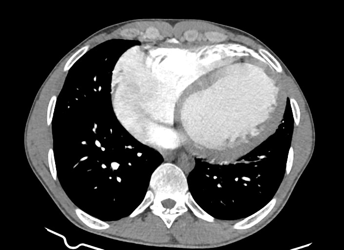 File:Aortic coarctation with aneurysm (Radiopaedia 74818-85828 A 75).jpg