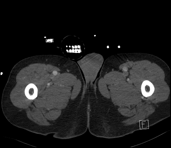 Aortic dissection (CTPA) (Radiopaedia 75506-86750 E 188).jpg