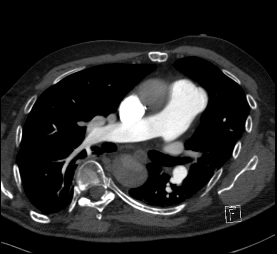 File:Aortic dissection (CTPA) (Radiopaedia 75506-86751 Axial C+ CTPA 68).jpg