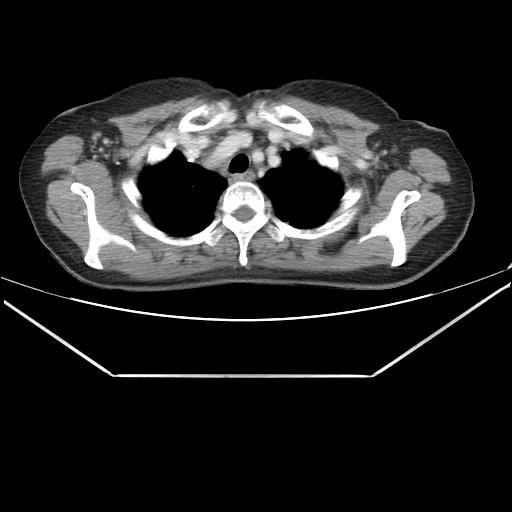 File:Aortic dissection (Radiopaedia 25350-25604 C 5).jpg
