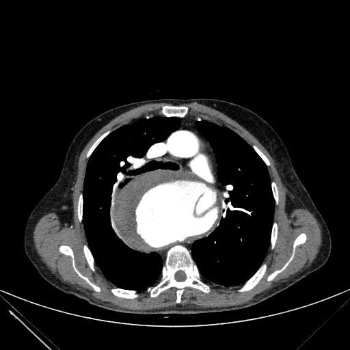 Aortic dissection (Radiopaedia 27466-27665 C+ arterial phase 88).jpg