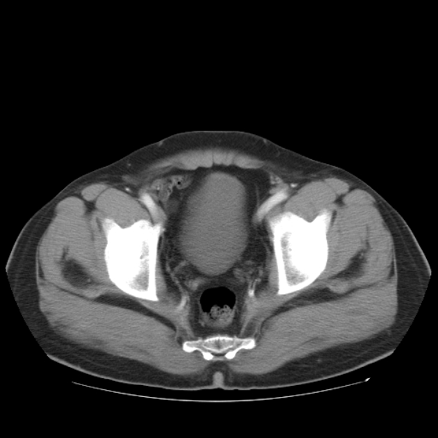 Aortic dissection (Radiopaedia 44411-48061 C 54).jpg