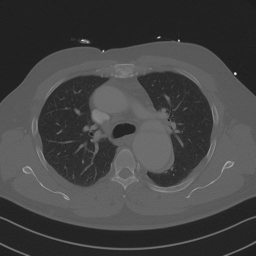 File:Aortic dissection (Radiopaedia 50763-56234 Axial bone window 42).png
