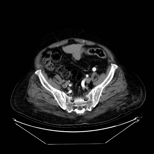 Aortic dissection (Radiopaedia 62562-71000 A 94).jpg