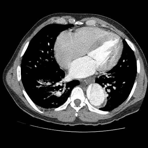 File:Aortic dissection - Stanford A -DeBakey I (Radiopaedia 28339-28587 B 65).jpg