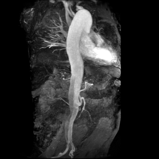 File:Aortic dissection - Stanford A - DeBakey I (Radiopaedia 23469-23551 MRA 4).jpg