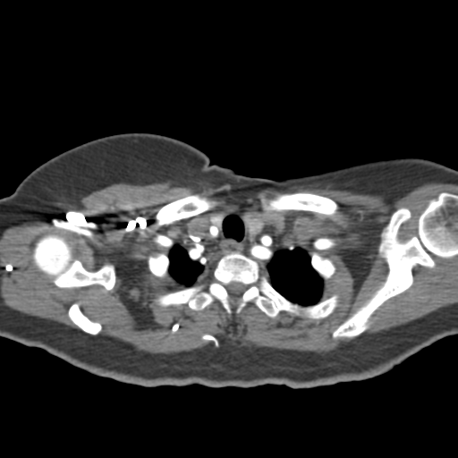 File:Aortic dissection - Stanford type A (Radiopaedia 39073-41259 A 7).png