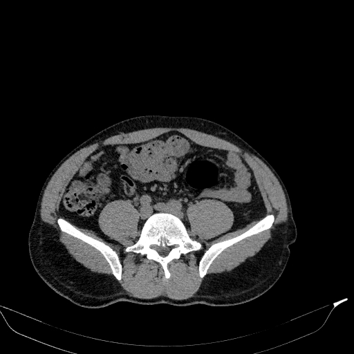 Aortic dissection - Stanford type A (Radiopaedia 83418-98500 Axial non-contrast 69).jpg