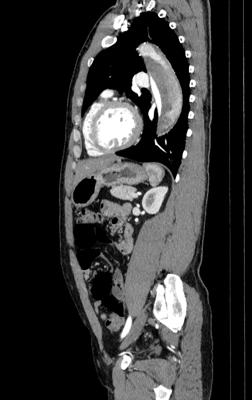 Aortic dissection - Stanford type A (Radiopaedia 83418-98500 B 62).jpg