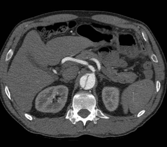Aortic dissection - Stanford type B (Radiopaedia 73648-84437 A 127).jpg