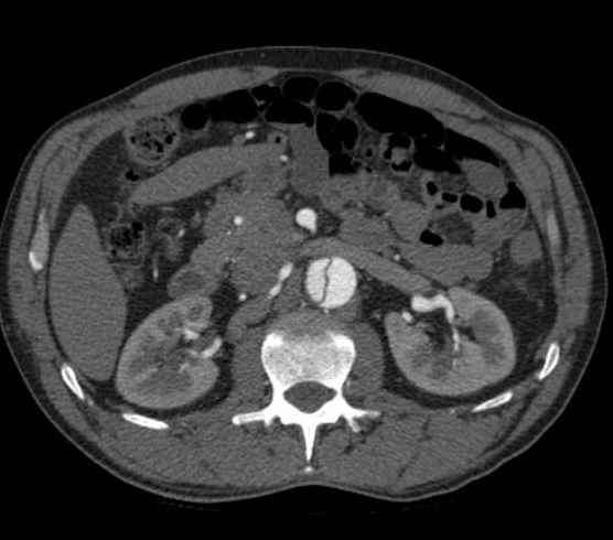 Aortic dissection - Stanford type B (Radiopaedia 73648-84437 A 144).jpg