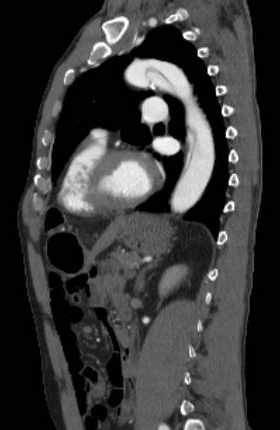 File:Aortic dissection - Stanford type B (Radiopaedia 73648-84437 C 58).jpg