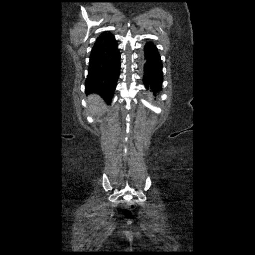 File:Aortic dissection - Stanford type B (Radiopaedia 88281-104910 B 79).jpg