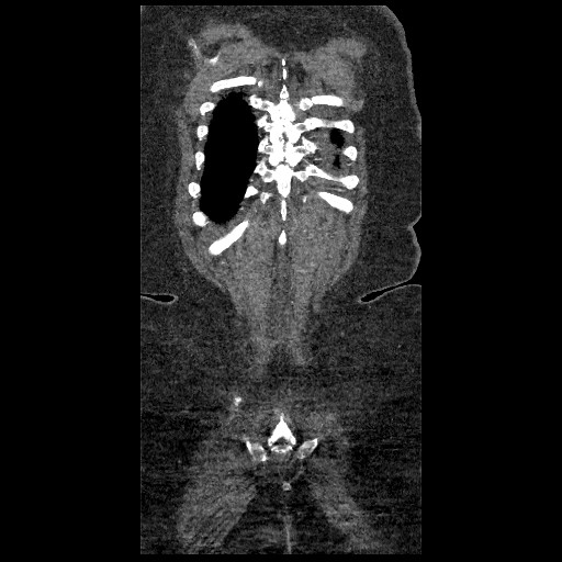 File:Aortic dissection - Stanford type B (Radiopaedia 88281-104910 B 84).jpg