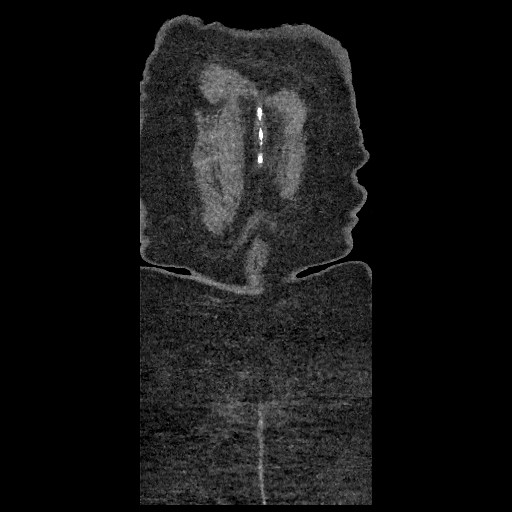 File:Aortic dissection - Stanford type B (Radiopaedia 88281-104910 B 94).jpg