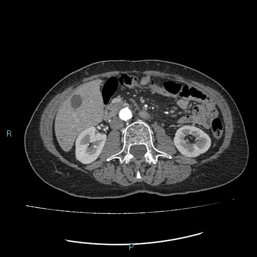 File:Aortic dissection extended to lusory artery (Radiopaedia 43686-47136 B 18).jpg