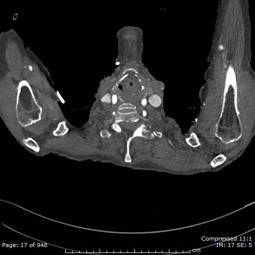 File:Aortic dissection with extension into aortic arch branches (Radiopaedia 64402-73204 B 17).jpg