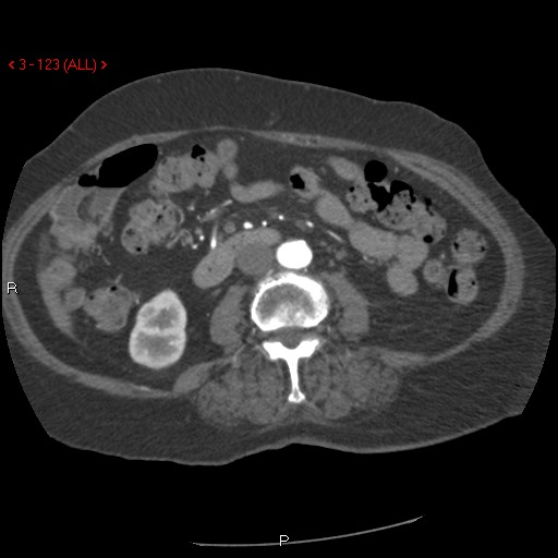 Aortic intramural hematoma (Radiopaedia 27746-28001 A 123).jpg