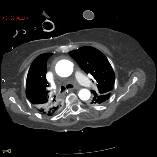File:Aortic intramural hematoma (Radiopaedia 27746-28001 A 36).jpg