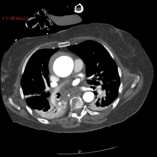Aortic intramural hematoma (Radiopaedia 27746-28001 A 48).jpg