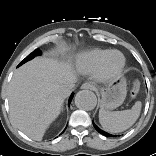Aortic intramural hematoma (Radiopaedia 31139-31838 Axial non-contrast 45).jpg