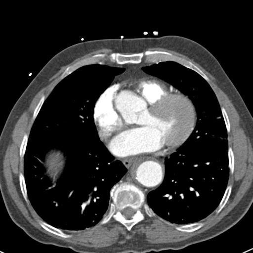 Aortic intramural hematoma (Radiopaedia 31139-31838 B 58).jpg