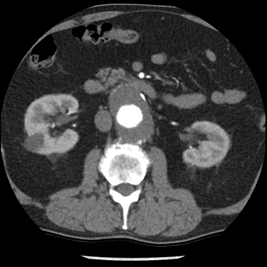 Aortic intramural hematoma (type B) (Radiopaedia 79323-92387 B 70).jpg