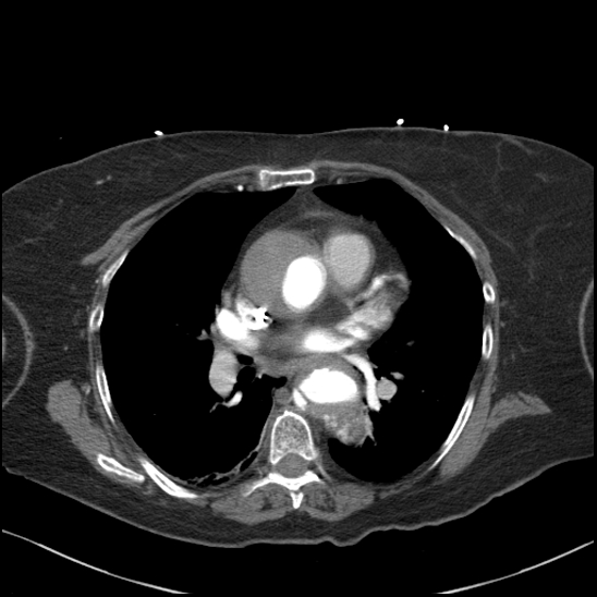 Aortic intramural hematoma with dissection and intramural blood pool (Radiopaedia 77373-89491 B 63).jpg