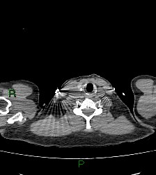 Aortic valve endocarditis (Radiopaedia 87209-103485 Axial non-contrast 1).jpg