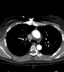 Aortic valve endocarditis (Radiopaedia 87209-103485 C 34).jpg
