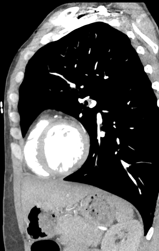 Aortic valve non-coronary cusp thrombus (Radiopaedia 55661-62189 C+ arterial phase 14).png