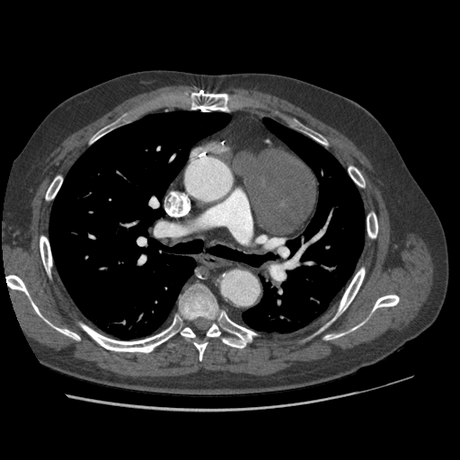File:Aorto-coronary bypass graft aneurysms (Radiopaedia 40562-43157 A 46).png