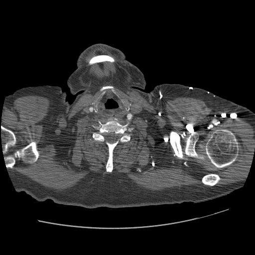 File:Aorto-coronary bypass graft aneurysms (Radiopaedia 40562-43157 A 6).png