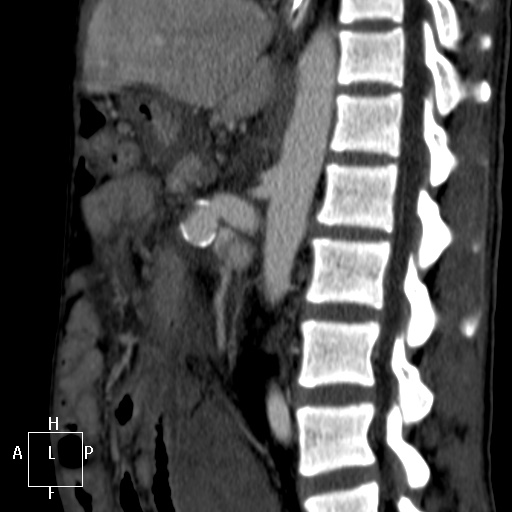 Aorto-left renal vein fistula (Radiopaedia 45534-49628 C 37).jpg