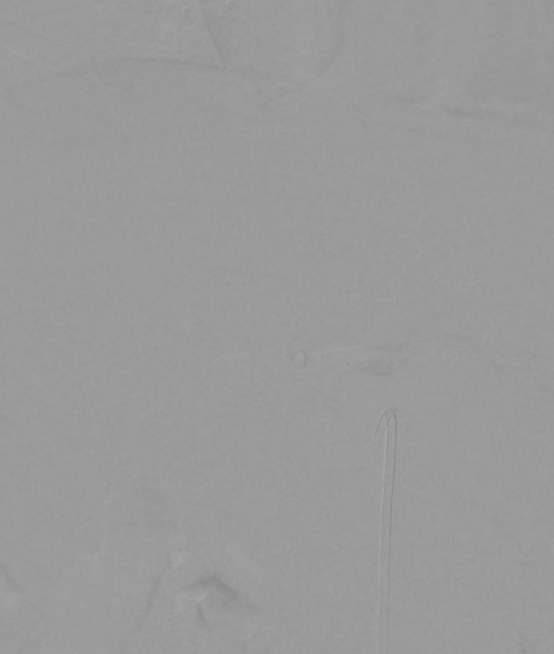 Aorto portal shunt (Radiopaedia 69573-79586 Frontal Celiac axis 3).jpg