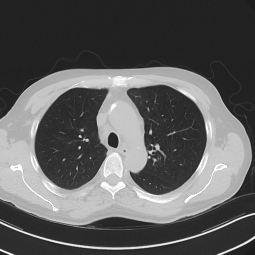 Apical pulmonary metastasis (Radiopaedia 46338-50754 Axial non-contrast 22).png
