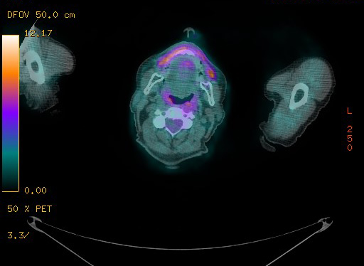 Appendiceal adenocarcinoma complicated by retroperitoneal abscess (Radiopaedia 58007-65041 Axial PET-CT 7).jpg