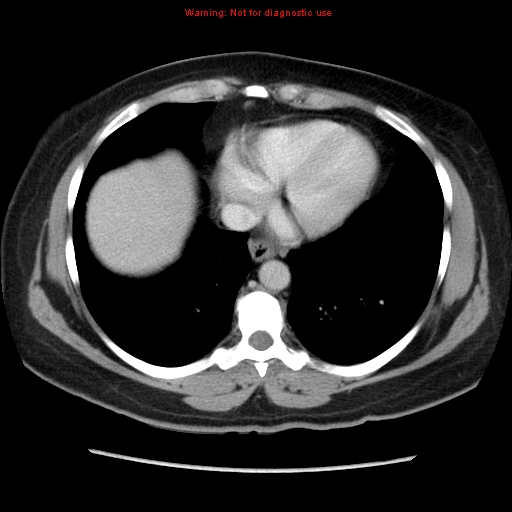 Appendiceal mucinous cystadenoma (Radiopaedia 8263-9111 Axial liver window 12).jpg