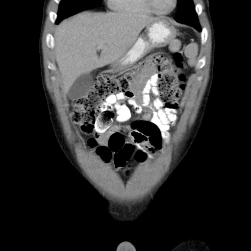 File:Appendicitis complicated by post-operative collection (Radiopaedia 35595-37113 B 15).jpg